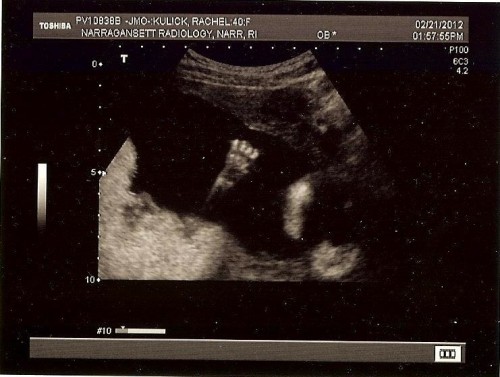 18-week ultrasound - hand