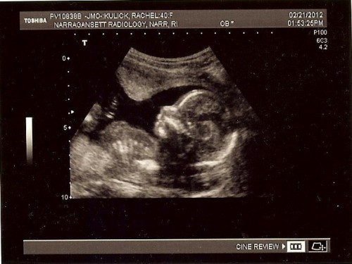 18-week ultrasound - ribs