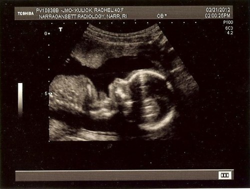 18-week ultrasound